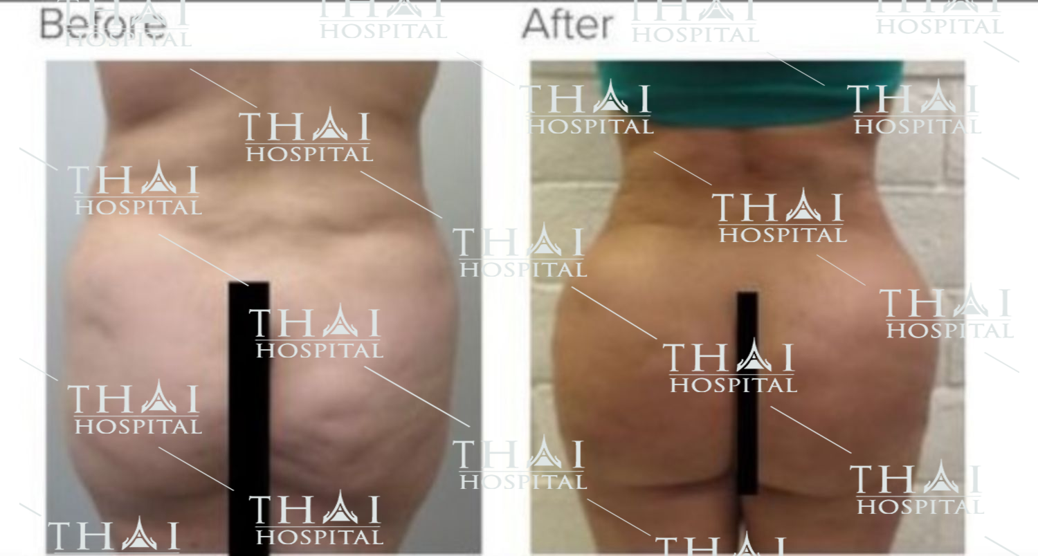 Hình ảnh khách hàng trước và sau khi nâng mông bằng mỡ tự thân