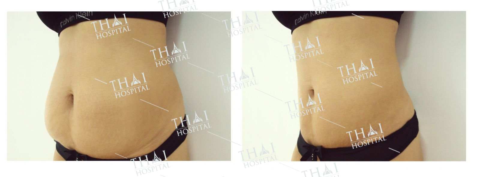 Khách hàng tại THAI Hospital trước và sau khi thực hiện hút mỡ và căng da bụng