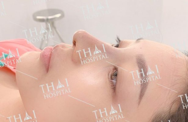 Giá nâng mũi sụn Surgiform tại THAI Hospital cạnh tranh nhất thị trường