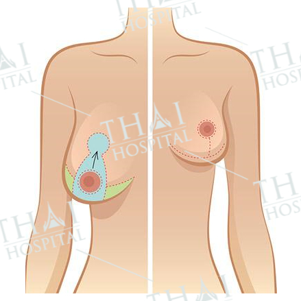 Treo tuyến trong là giải pháp giúp chị em khắc phục hiện tượng ngực chảy xệ, không cân xứng