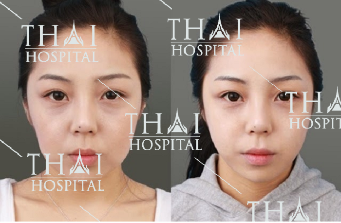 Kỹ thuật trẻ hóa làn da giúp chị em phụ nữ trẻ lại từ 5 - 7 tuổi