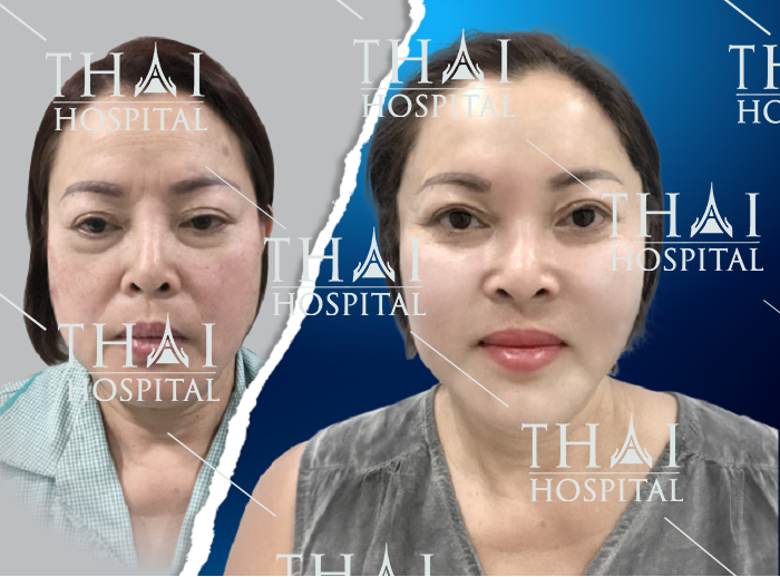 Kỹ thuật căng da mặt giúp khắc phục mọi khuyết điểm lão hóa