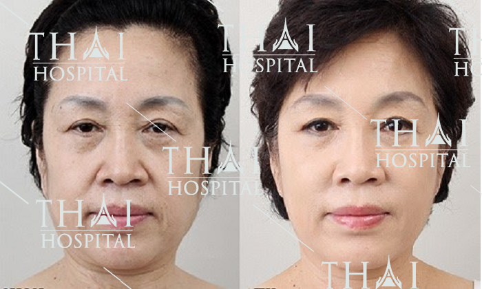 Căng da SMAS phù hợp với tất cả khách hàng có khuyết điểm da lão hóa