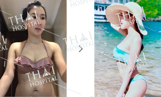 Khách hàng trước và sau khi thực hiện combo body hoàn hảo tại THAI Hospital