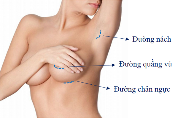 Nâng ngực nội soi và 4 con đường chọn lựa