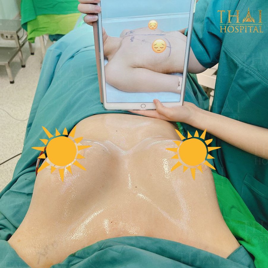Hình ảnh nâng ngực thành công tại Viện Thẩm Mỹ Thái Hospital