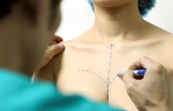 Nâng ngực ở Bình Thuận với kỹ thuật phẫu thuật nội soi