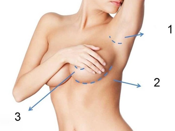 Các vị trí rạch nếu thực hiện nâng ngực bằng phương pháp phẫu thuật